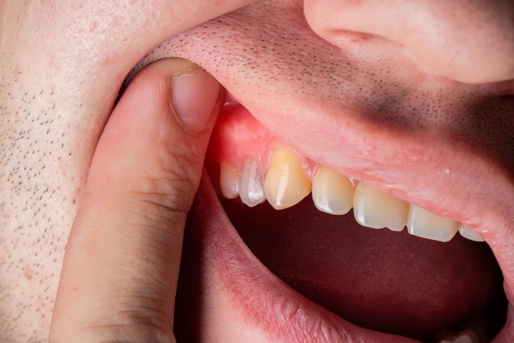 Absceso periodontal | Ester Rodriguez Clínica en Salamanca