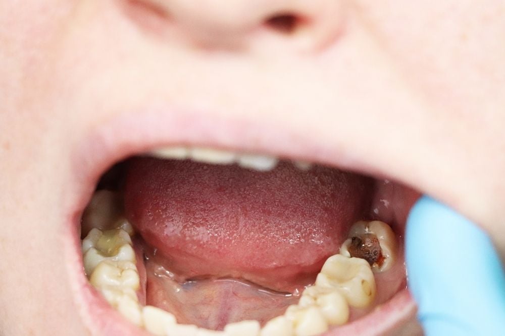 Caries profunda / Ester Rodríguez Clínica Dental