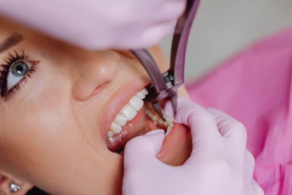 ¿Cuánto tarda en cicatrizar un implante dental? / Ester Rodriguez Clínica Dental