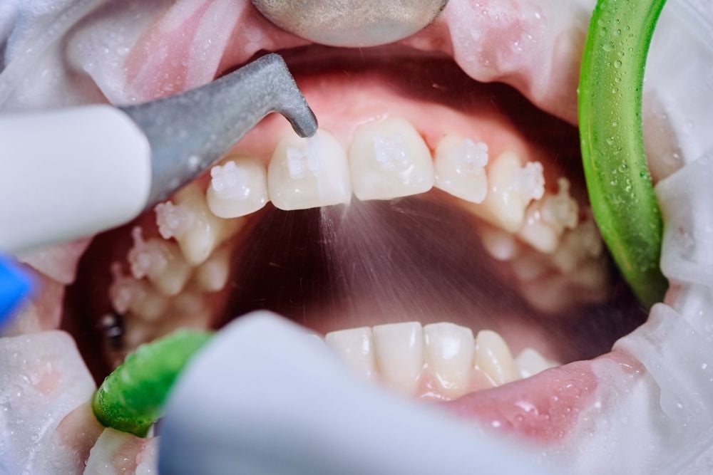¿Es dolorosa la limpieza dental con ultrasonido?