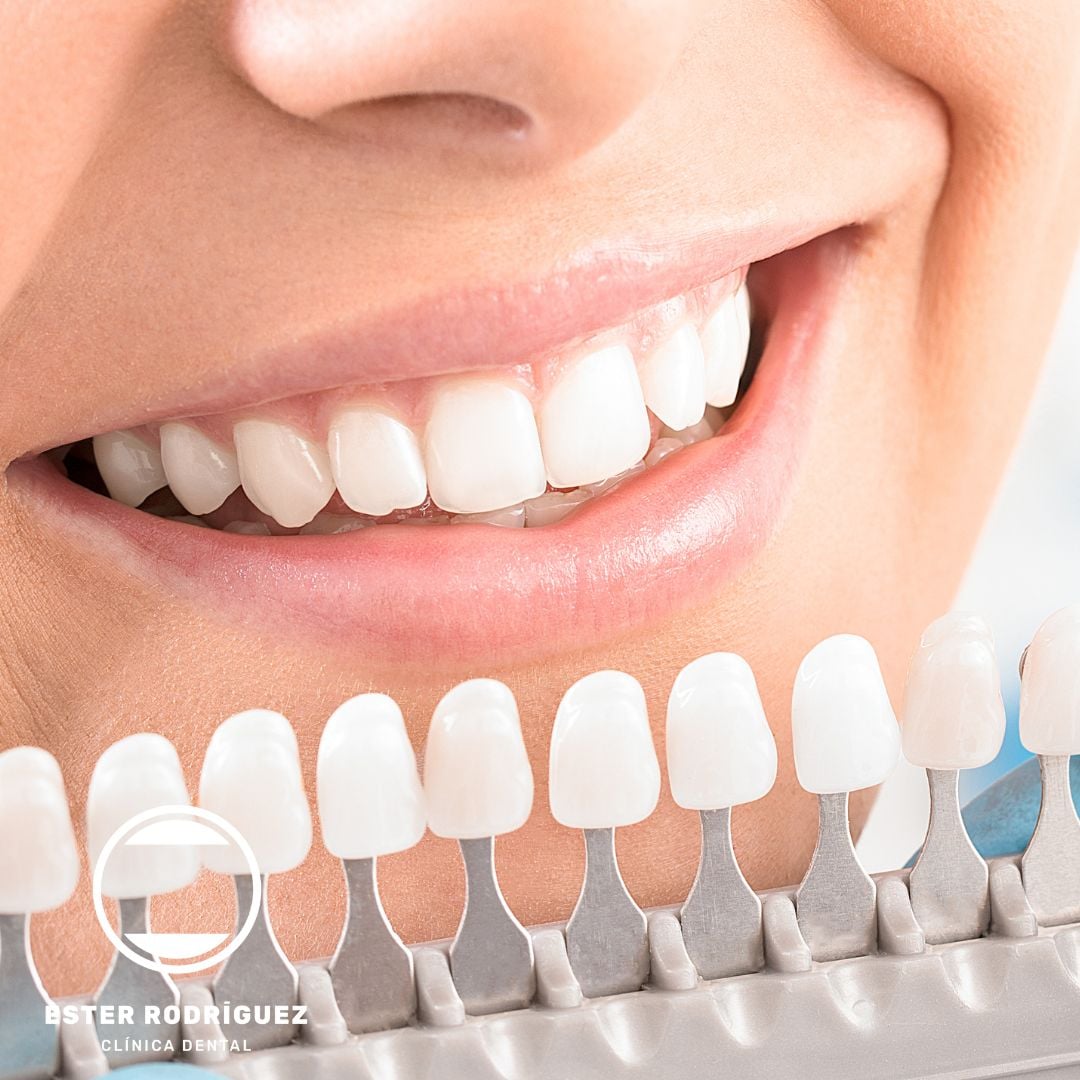 Limpieza dental en Salamanca | Ester Clínica Dental