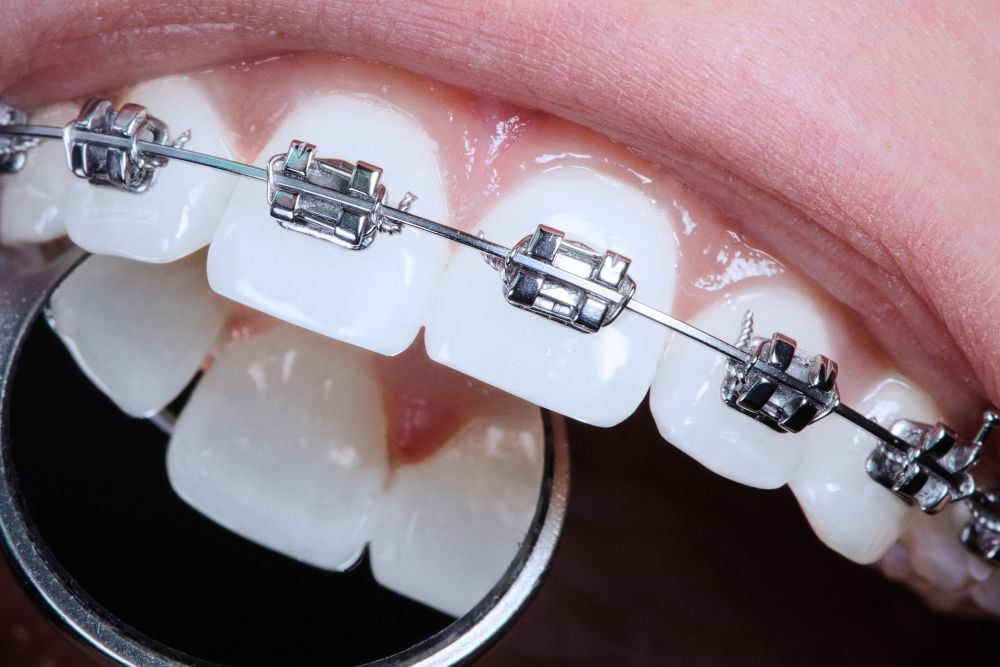 Ortodoncia: ¿Qué es y cómo puede benediciarte? | Ester Rodríguez Clínica Dental en Salamanca