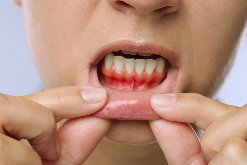 Retracción de encías - Ester Rodríguez Clínica Dental