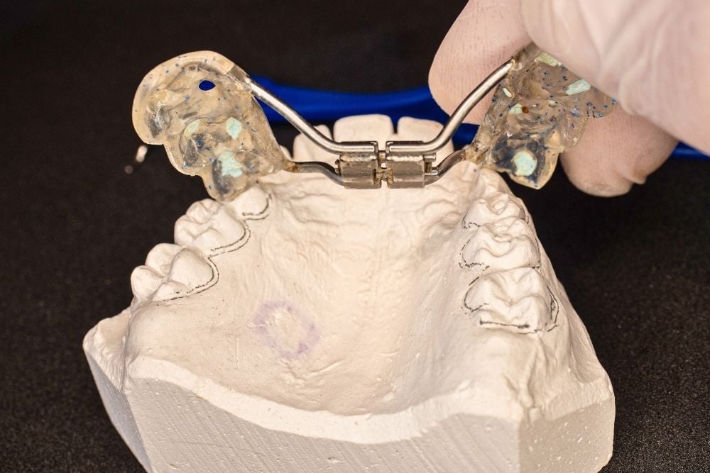 Torus maxilar: qué es y cuándo hay que tratarlo / Ester Rodriguez Clínica Dental