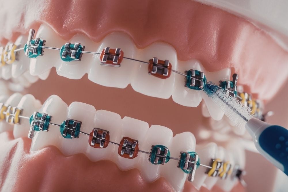 Tratamiento de ortodoncia en Salamanca / Ester Rodríguez Clínica Dental