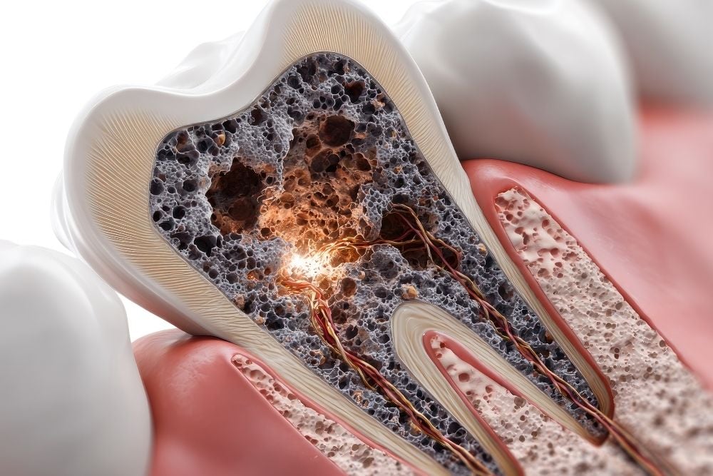 Cómo se mata el nervio de una muela / Ester Rodríguez Clínica Dental