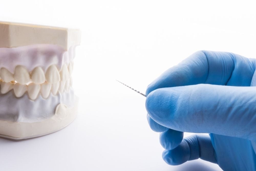 ¿Cuánto dura una endodoncia? / Ester Rodríguez Clínica Dental