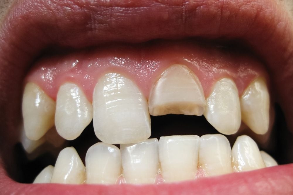 Diente fracturado / Ester Rodríguez Clínica Dental