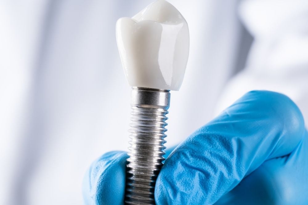 Implantes dentales sin hueso: soluciones cuando falta hueso dental / Ester Rodríguez Clínica Dental