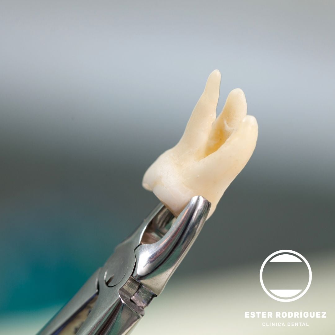 Extracción Dental en Salamanca | Ester Rodríguez Clínica Dental