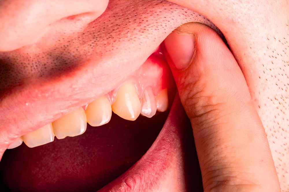 ¿Qué es un absceso en la encía y cómo tratarlo? / Ester Rodriguez Clínica Dental