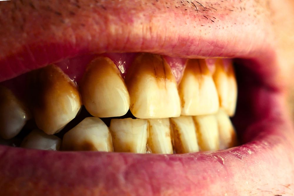 ¿Qué alimentos manchan los dientes?