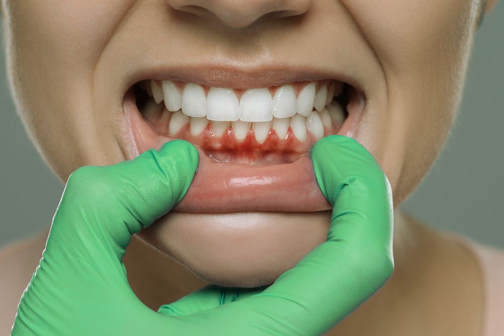 Cómo cuidar las encías para una salud bucal óptima