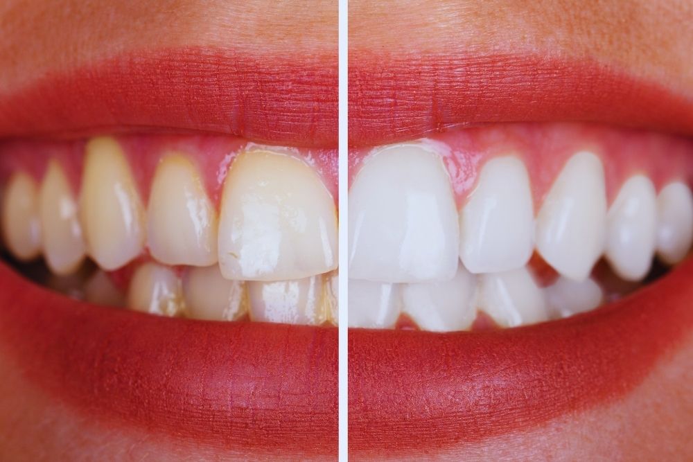 Blanqueamiento dental con férulas para una sonrisa más brillante