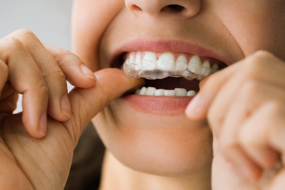 Cómo tratar el bruxismo con férula de descarga | Ester Rodriguez Clínica Dental