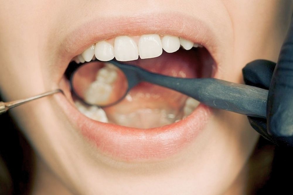 Mucoceles: qué son, causas y tratamientos en Clínica Dental Ester Rodríguez