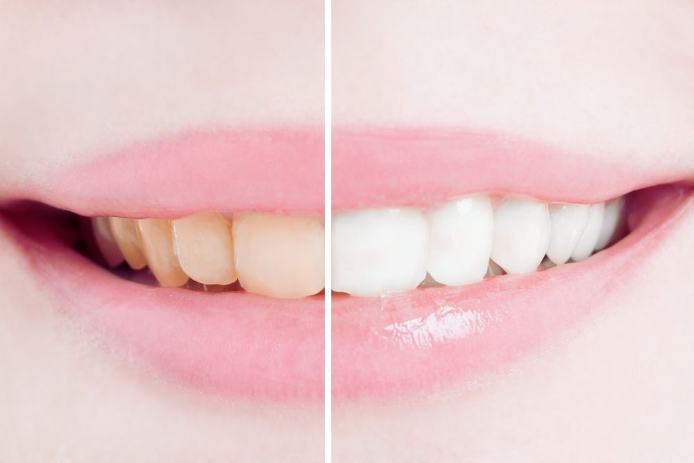 ¿Es malo blanquearse los dientes? Todo lo que debes saber