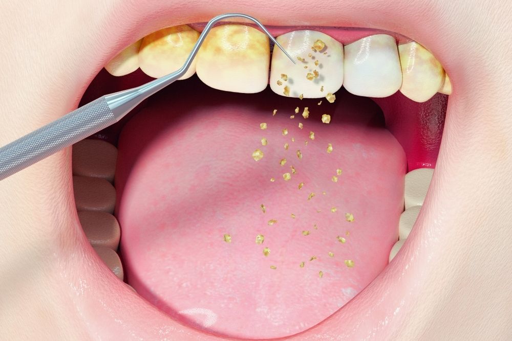 Placa dental: Causas, efectos y cómo prevenirla
